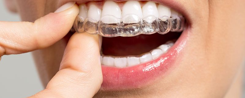 Achieve a Healthier Smile with Invisalign: The Clear Path to Dental Wellness